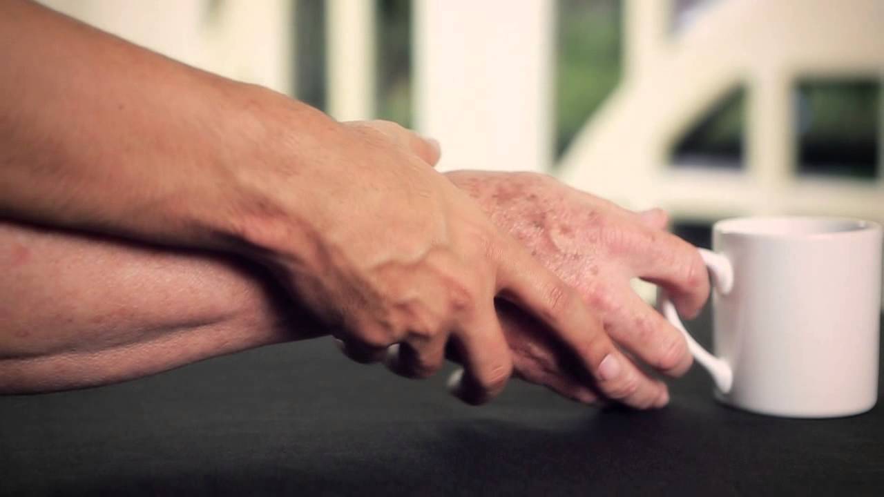Rehabilitación Integral. Enfermedad de Parkinson. Parte I